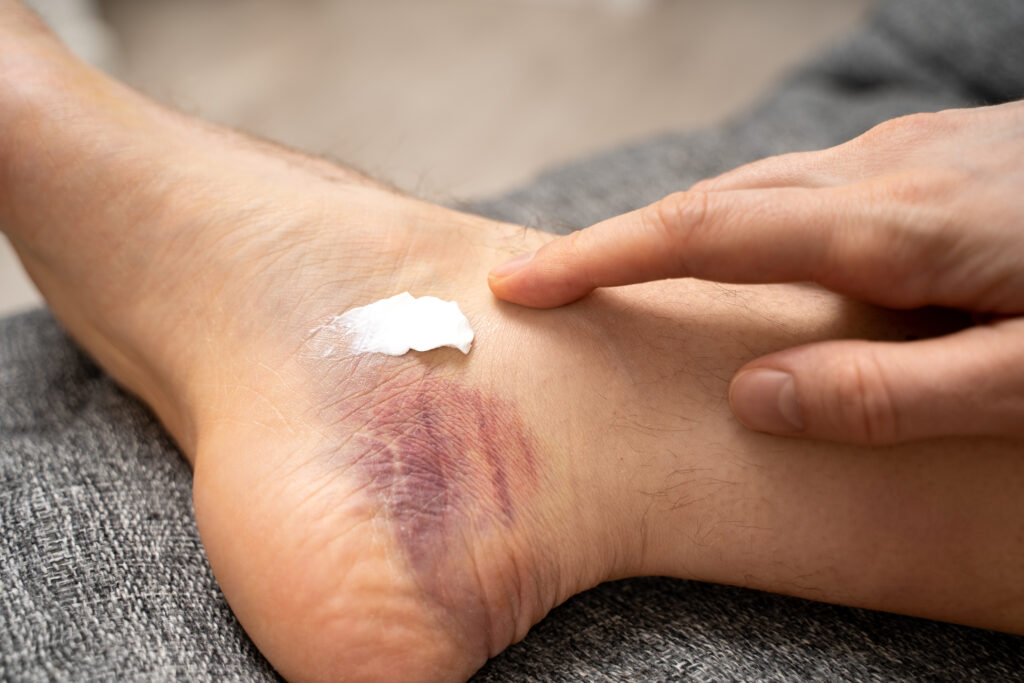 Learn about soft tissue injuries - common causes, symptoms, and treatment options to promote your recovery.