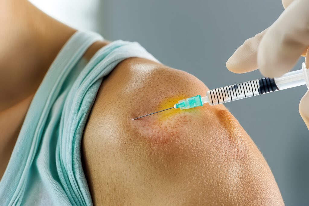 Picture of shoulder botox injection techniques for pain management, highlighting tendon and muscle strain areas.