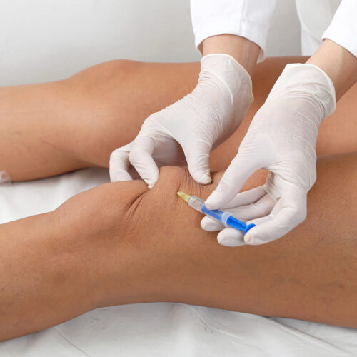 Leg botox A healthcare professional wearing white gloves administers a Botox injection into a patient’s knee area. The patient is lying down with the leg extended while the provider carefully inserts the syringe into the skin.