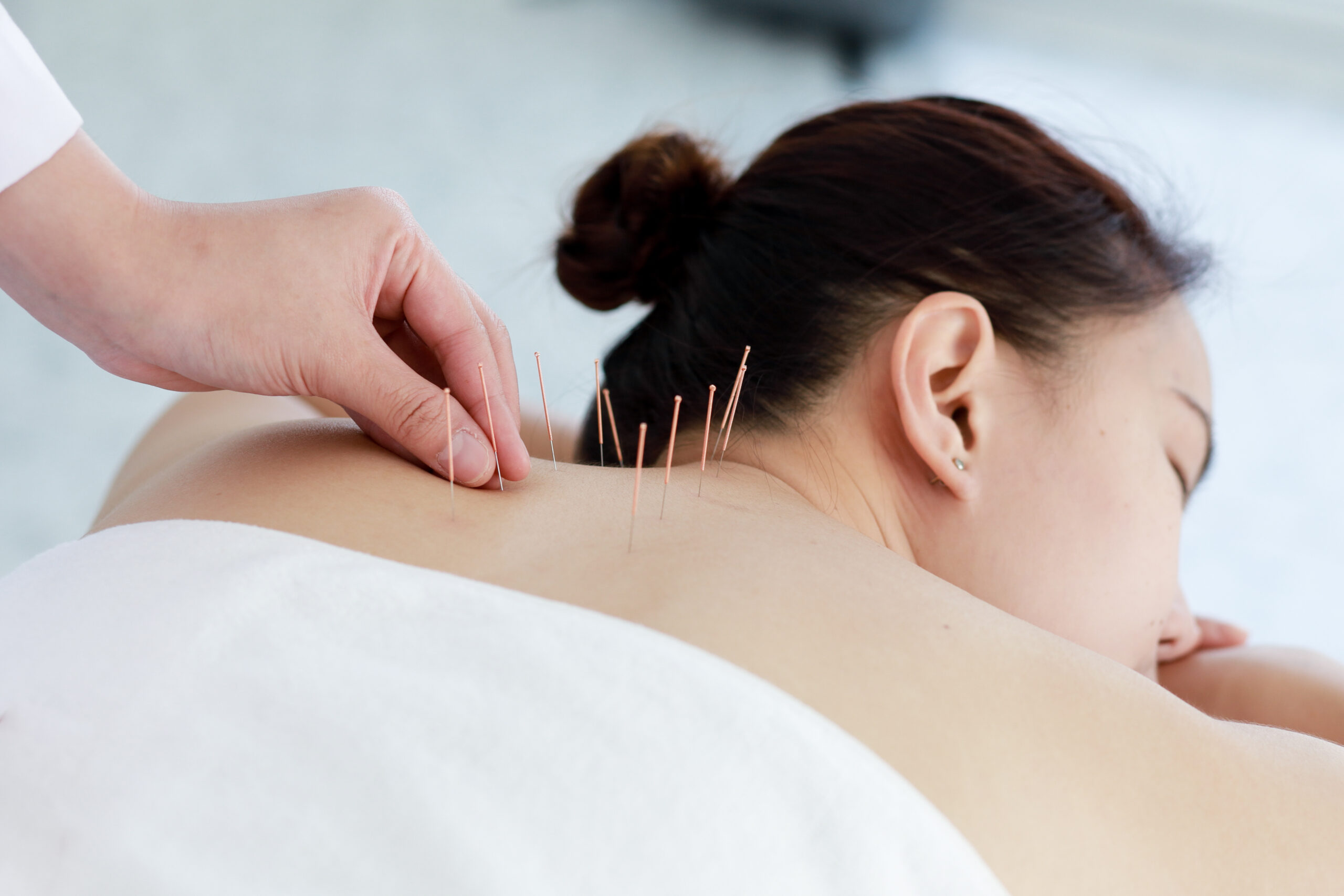 Doctor performing acupuncture therapy on a patient with fine needles inserted along the skin, showing the acupuncture treatment process in a clinical setting.