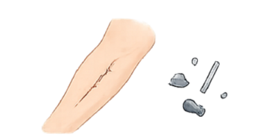 Metal fragments from prior injuries or work accidents Metal fragments from prior injuries or work accidents