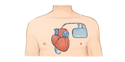 Pacemakers or stimulators Pacemakers or stimulators