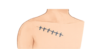 Surgical clips or implanted devices Surgical clips or implanted devices